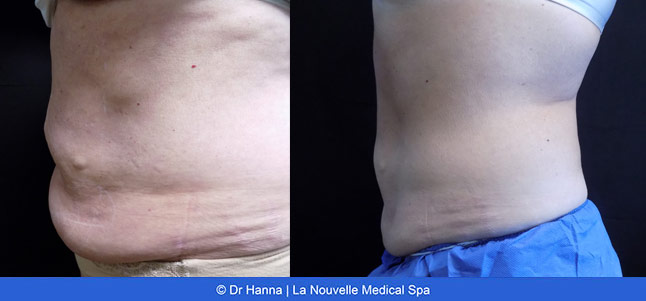 Coolsculpting before after photos, La Nouvelle Medical Spa, Oxnard, Ventura county  