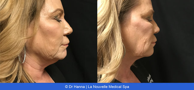 Coolsculpting before after photos, La Nouvelle Medical Spa, Oxnard, Ventura county  