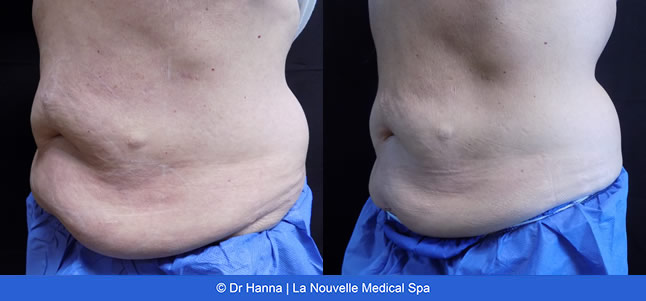 Coolsculpting before after photos, La Nouvelle Medical Spa, Oxnard, Ventura county  