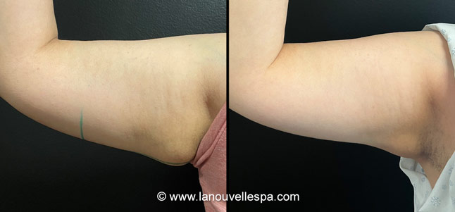 Coolsculpting before after photos arm, La Nouvelle Medical Spa, Oxnard, Ventura county  