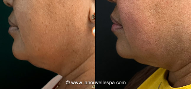 Coolsculpting before after photos neck side, La Nouvelle Medical Spa, Oxnard, Ventura county  